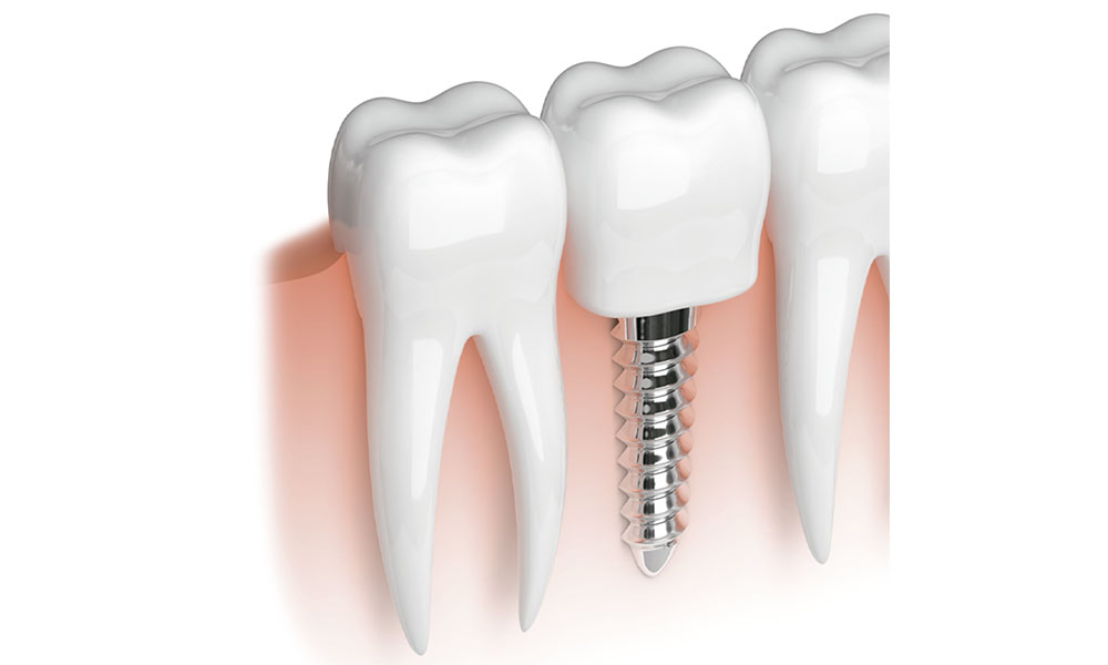 Smile Designers | Zirconium crowns | Aesthetic dentistry